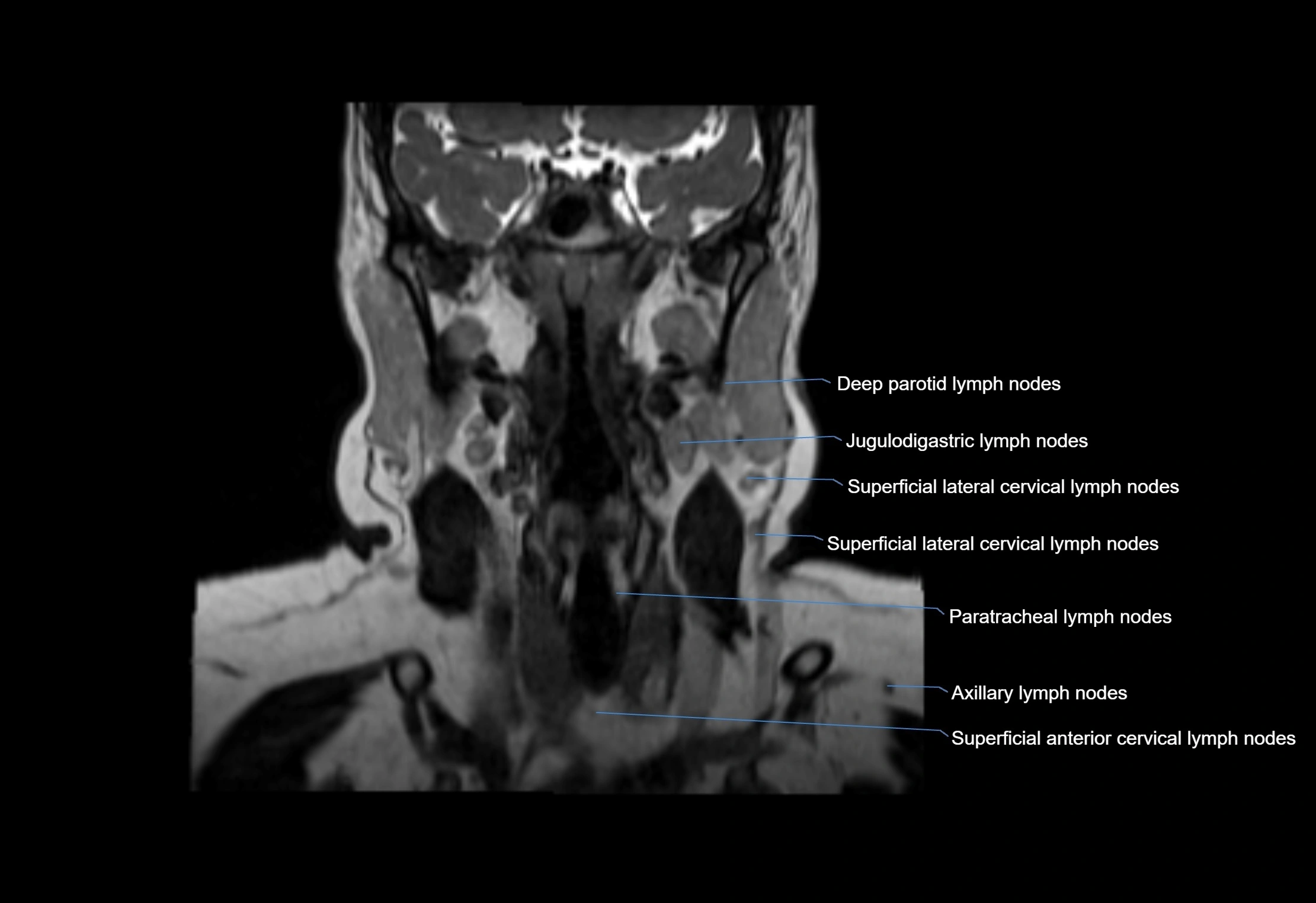 Neck coronal lymph node cross sectional MRI anatomy 3T MRI  image-img-00001-00041.webp